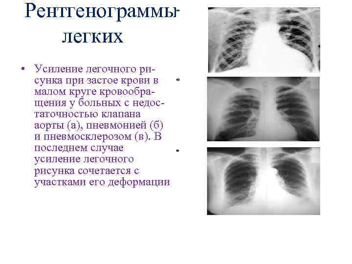 Корни уплотнены легочный рисунок деформирован в прикорневых зонах аорта уплотнена