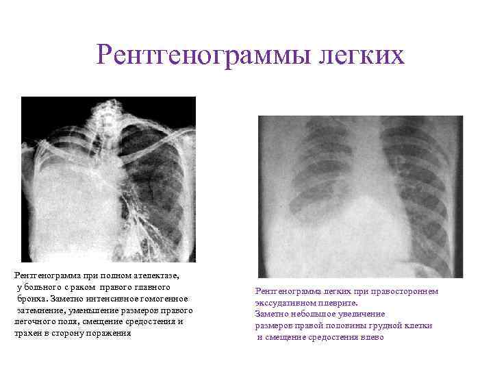 Ателектазы рентген схема