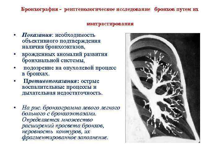 Бронхография - рентгенологическое исследование бронхов путем их контрастирования • Показания: необходимость объективного подтверждения наличия