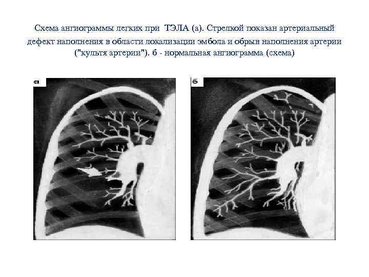 Ксарелто при тэла схема