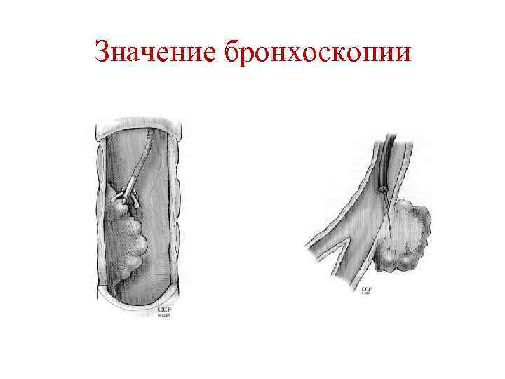 Значение бронхоскопии 