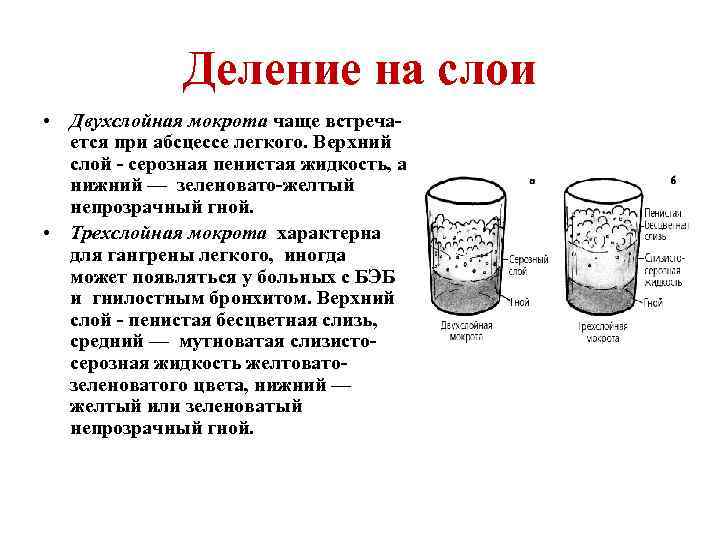 Серозная жидкость. 3 Слоя мокроты при абсцессе. Трехслойность мокроты после отстаивания характерна для. Трехслойная мокрота характерна для. Для мокроты при абсцессе лёгкого характерны.