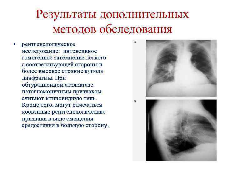Результаты дополнительных методов обследования • рентгенологическое исследование: интенсивное гомогенное затемнение легкого с соответствующей стороны