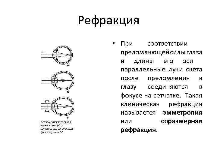 Изучите физиологию зрения рассмотрите схемы рефракции при нормальном зрении