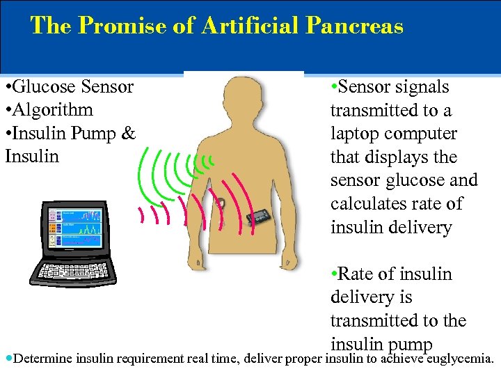 The Promise of Artificial Pancreas • Glucose Sensor • Algorithm • Insulin Pump &