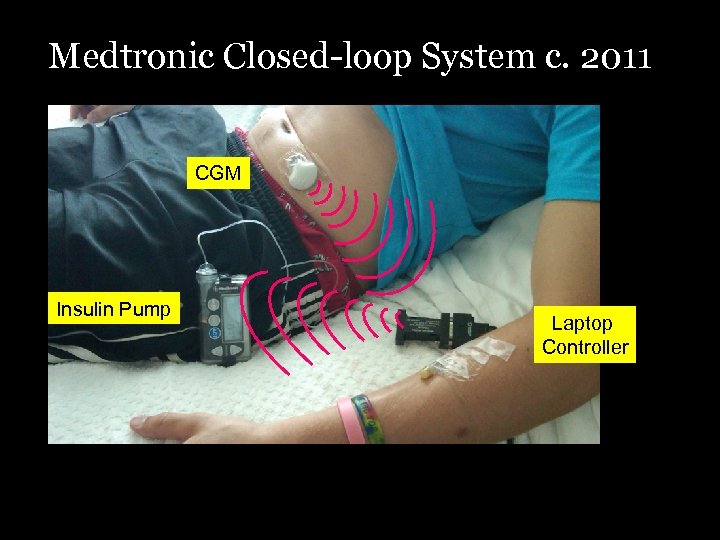 Medtronic Closed-loop System c. 2011 CGM Insulin Pump Laptop Controller 