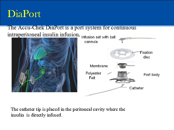 Dia. Port The Accu-Chek Dia. Port is a port system for continuous intraperitoneal insulin