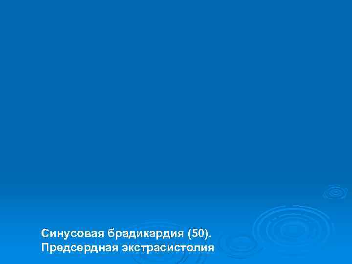 Синусовая брадикардия (50). Предсердная экстрасистолия 