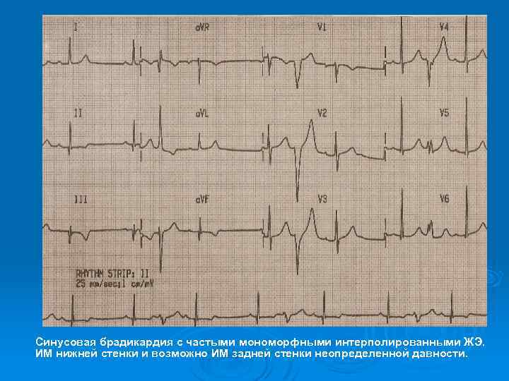 Синусовая брадикардия с частыми мономорфными интерполированными ЖЭ. ИМ нижней стенки и возможно ИМ задней