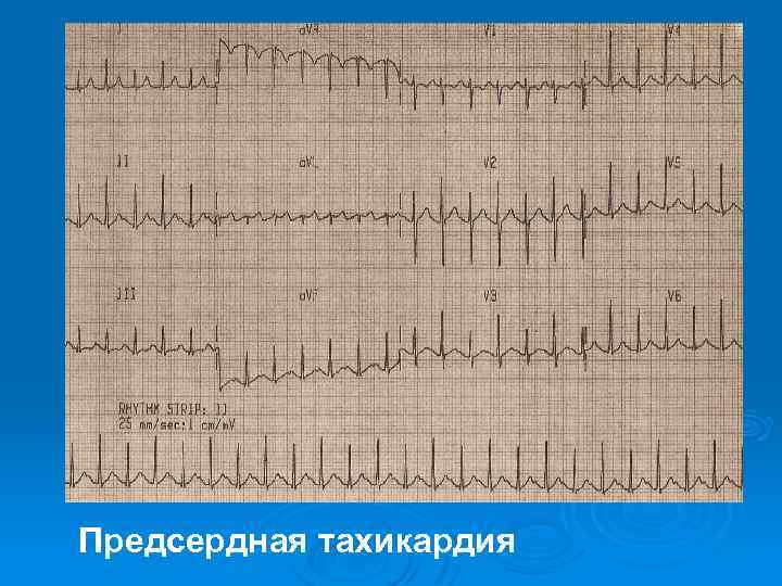 Предсердная тахикардия 