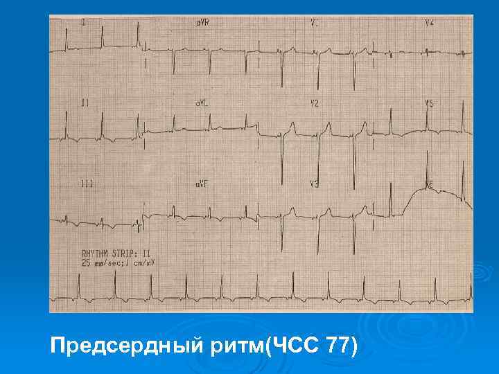 Предсердный ритм(ЧСС 77) 