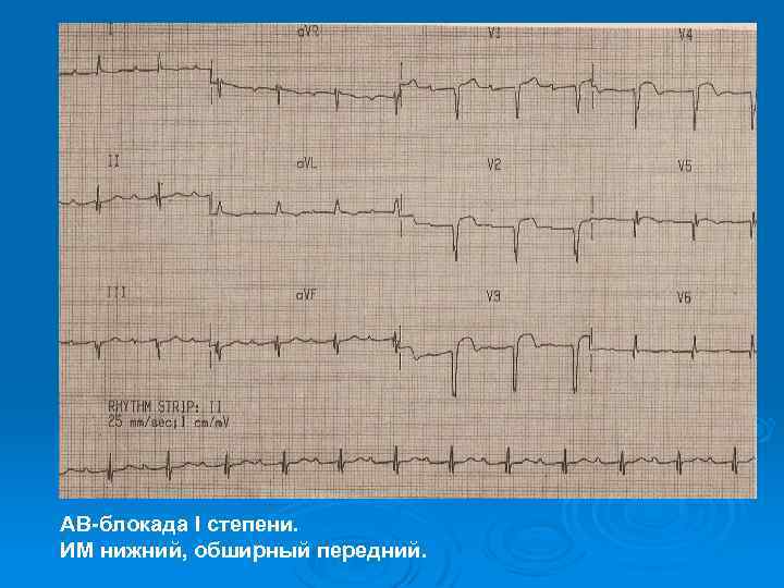 АВ-блокада I степени. ИМ нижний, обширный передний. 
