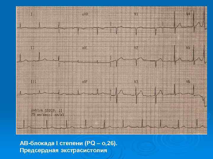 АВ-блокада I степени (РQ – о, 26). Предсердная экстрасистолия 