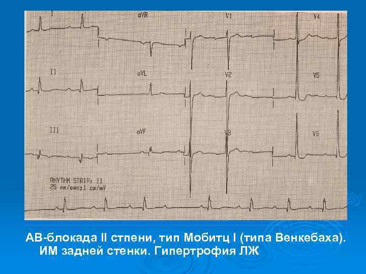 АВ-блокада II стпени, тип Мобитц I (типа Венкебаха). ИМ задней стенки. Гипертрофия ЛЖ 