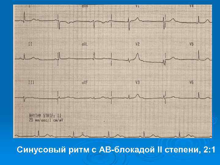 Синусовый ритм с АВ-блокадой II степени, 2: 1 