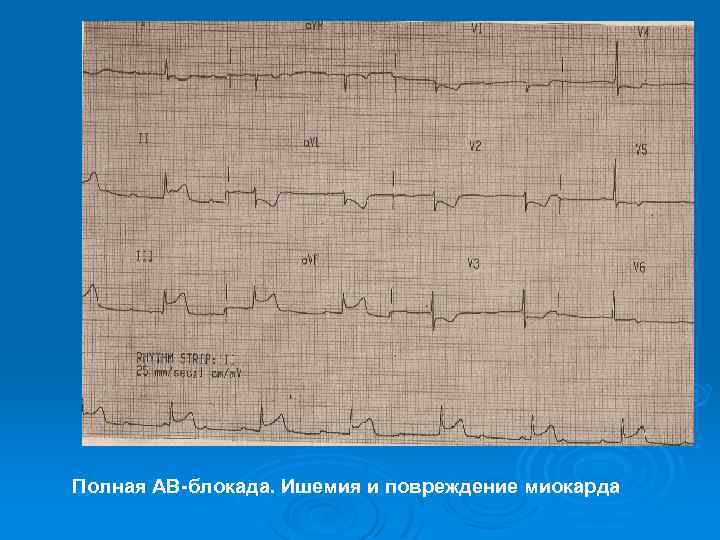 Полная АВ-блокада. Ишемия и повреждение миокарда 