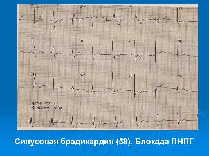 Синусовая брадикардия (58). Блокада ПНПГ 