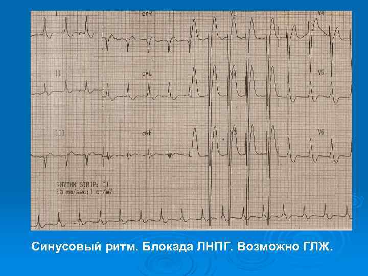 Синусовый ритм. Блокада ЛНПГ. Возможно ГЛЖ. 