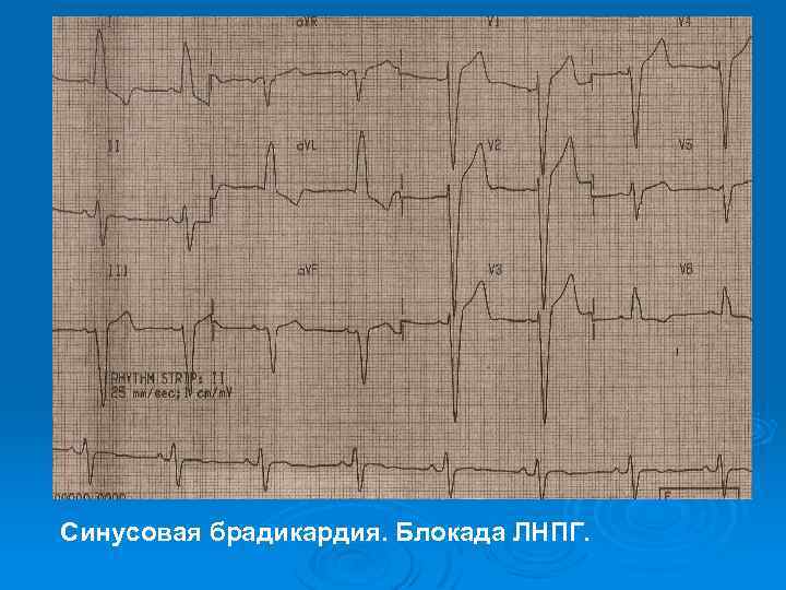 Синусовая брадикардия. Блокада ЛНПГ. 