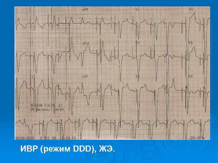 ИВР (режим DDD), ЖЭ. 