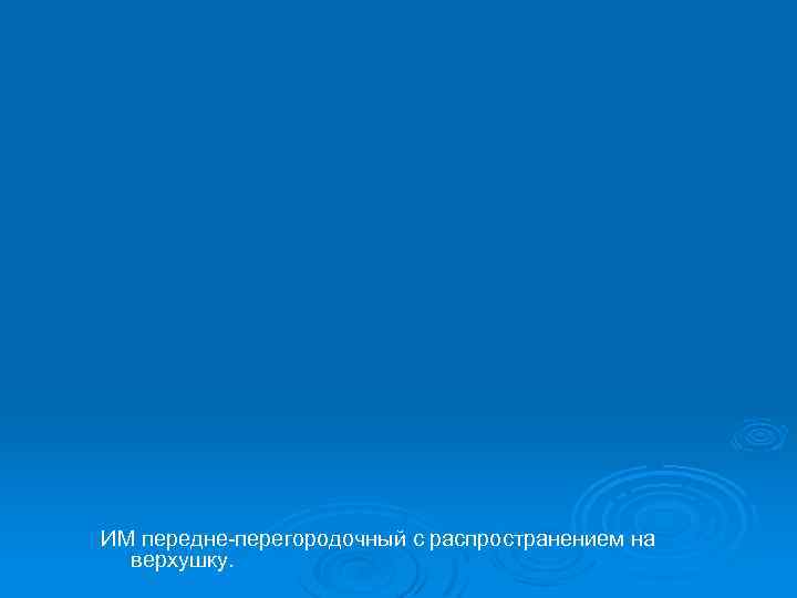 ИМ передне-перегородочный с распространением на верхушку. 