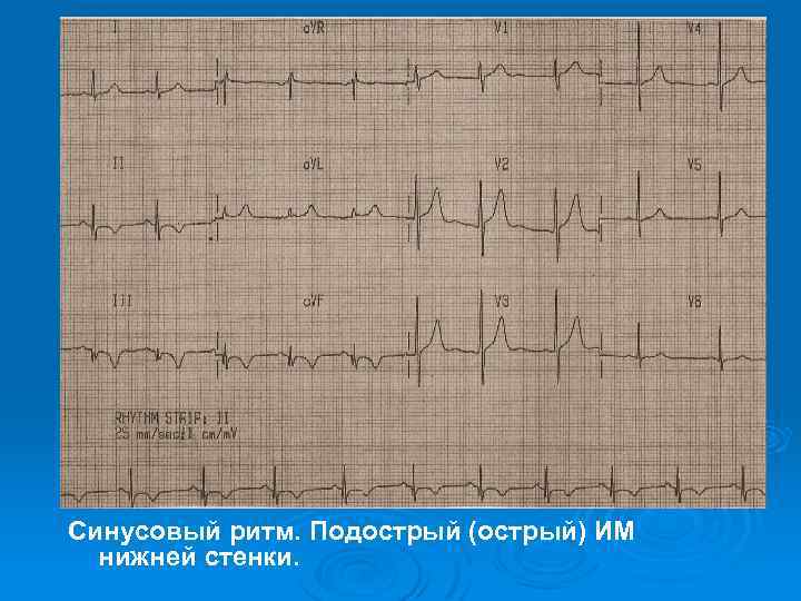 Синусовый ритм. Подострый (острый) ИМ нижней стенки. 