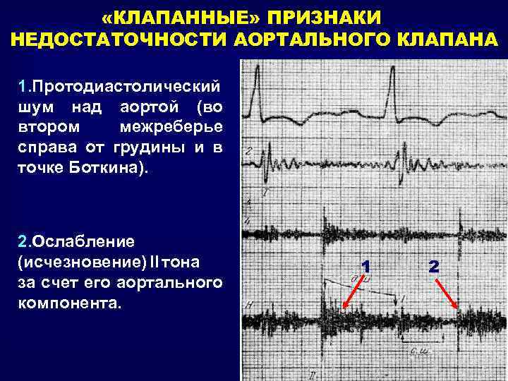  «КЛАПАННЫЕ» ПРИЗНАКИ НЕДОСТАТОЧНОСТИ АОРТАЛЬНОГО КЛАПАНА 1. Протодиастолический шум над аортой (во втором межреберье