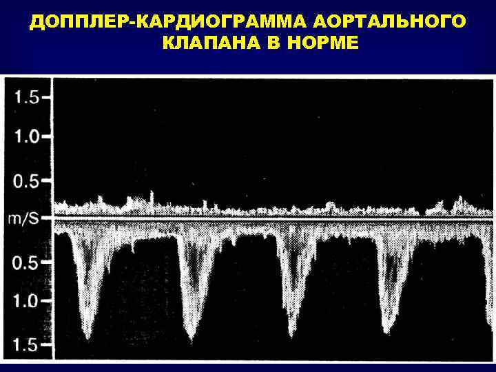 ДОППЛЕР-КАРДИОГРАММА АОРТАЛЬНОГО КЛАПАНА В НОРМЕ 