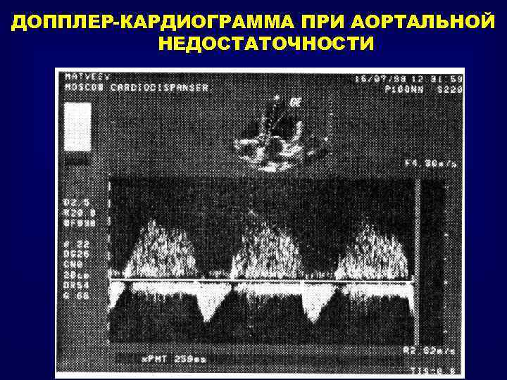 ДОППЛЕР-КАРДИОГРАММА ПРИ АОРТАЛЬНОЙ НЕДОСТАТОЧНОСТИ 