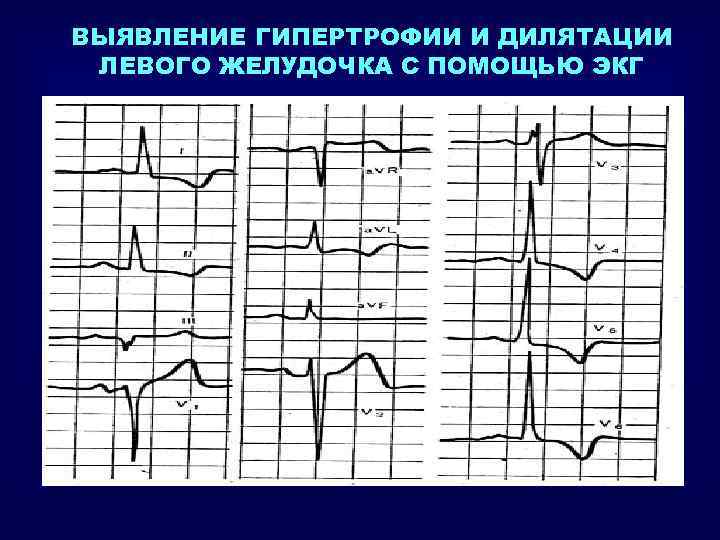 ВЫЯВЛЕНИЕ ГИПЕРТРОФИИ И ДИЛЯТАЦИИ ЛЕВОГО ЖЕЛУДОЧКА С ПОМОЩЬЮ ЭКГ 