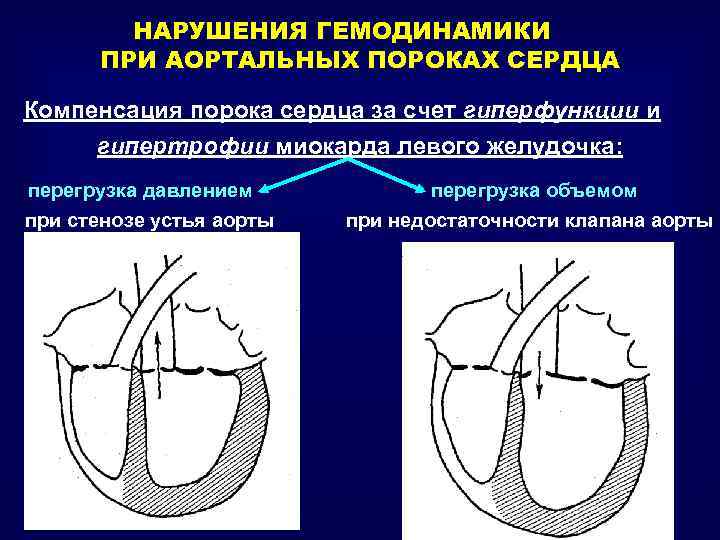 НАРУШЕНИЯ ГЕМОДИНАМИКИ ПРИ АОРТАЛЬНЫХ ПОРОКАХ СЕРДЦА Компенсация порока сердца за счет гиперфункции и гипертрофии