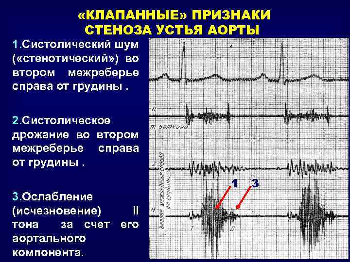  «КЛАПАННЫЕ» ПРИЗНАКИ СТЕНОЗА УСТЬЯ АОРТЫ 1. Систолический шум ( «стенотический» ) во втором