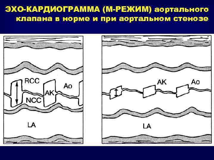 ЭХО-КАРДИОГРАММА (М-РЕЖИМ) аортального клапана в норме и при аортальном стенозе 