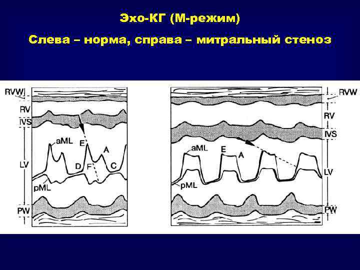 После эхо. М режим митрального клапана. Стеноз митрального клапана м режим. Митральный стеноз в м режиме. ЭХОКГ митральный стеноз м и в режим.