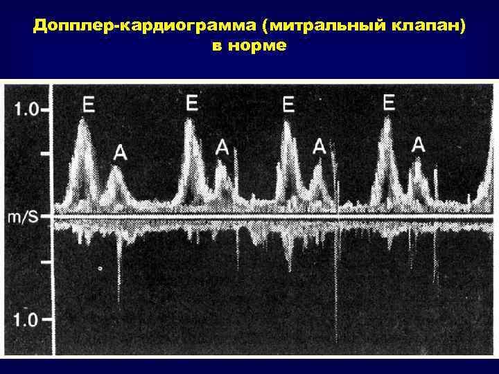 Допплерометрия трикуспидального клапана норма