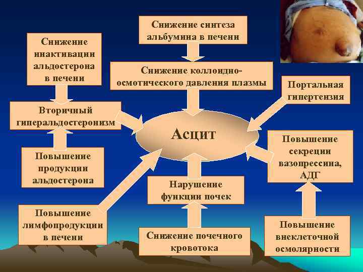 Снижение инактивации альдостерона в печени Вторичный гиперальдостеронизм Повышение продукции альдостерона Повышение лимфопродукции в печени