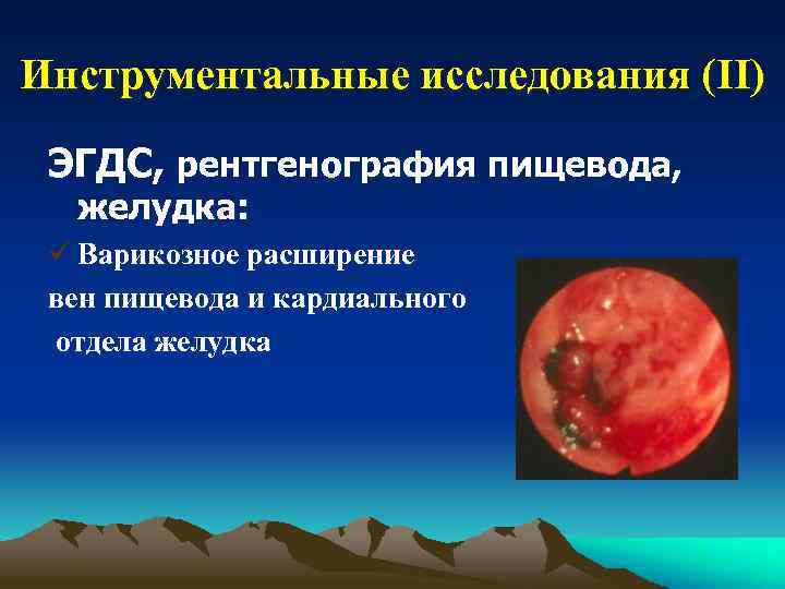 Инструментальные исследования (II) ЭГДС, рентгенография пищевода, желудка: ü Варикозное расширение вен пищевода и кардиального