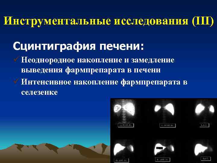 Инструментальные исследования (III) Сцинтиграфия печени: ü Неоднородное накопление и замедление выведения фармпрепарата в печени