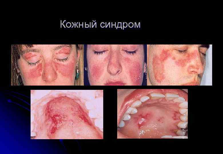 Кожный синдром 