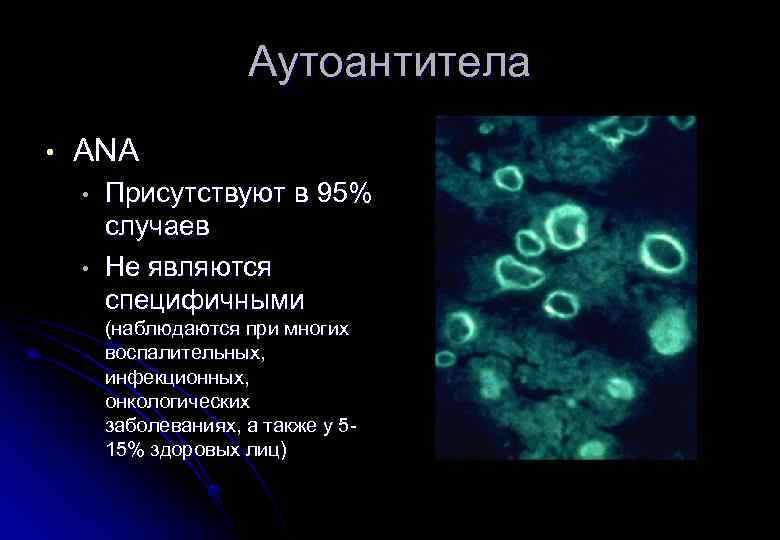 Аутоантитела • ANA • • Присутствуют в 95% случаев Не являются специфичными (наблюдаются при