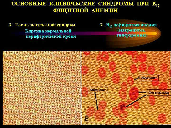 Б12 дефицитная анемия клинические рекомендации