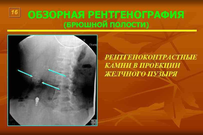 16 ОБЗОРНАЯ РЕНТГЕНОГРАФИЯ (БРЮШНОЙ ПОЛОСТИ) РЕНТГЕНОКОНТРАСТНЫЕ КАМНИ В ПРОЕКЦИИ ЖЕЛЧНОГО ПУЗЫРЯ 