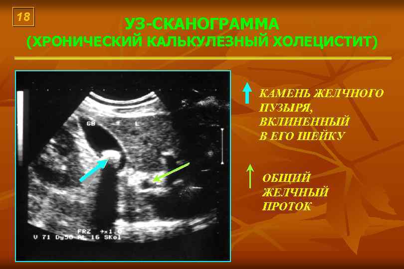 18 УЗ-СКАНОГРАММА (ХРОНИЧЕСКИЙ КАЛЬКУЛЕЗНЫЙ ХОЛЕЦИСТИТ) КАМЕНЬ ЖЕЛЧНОГО ПУЗЫРЯ, ВКЛИНЕННЫЙ В ЕГО ШЕЙКУ ОБЩИЙ ЖЕЛЧНЫЙ
