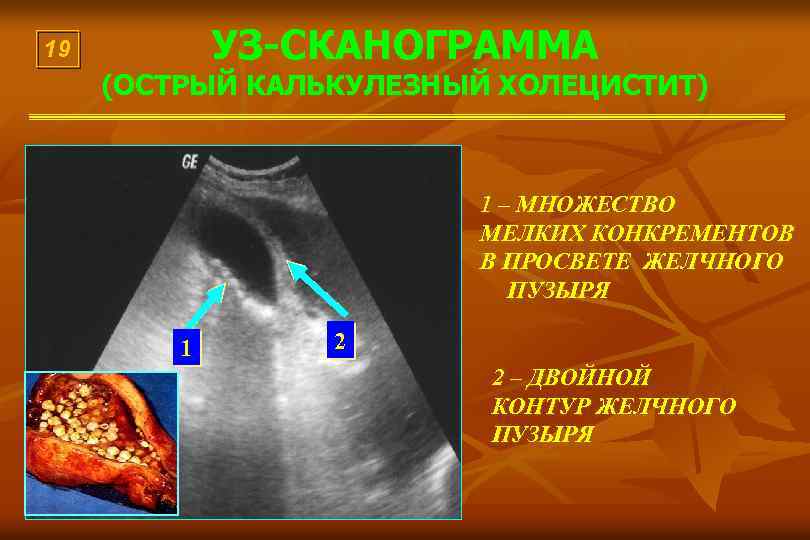 УЗ-СКАНОГРАММА 19 (ОСТРЫЙ КАЛЬКУЛЕЗНЫЙ ХОЛЕЦИСТИТ) 1 – МНОЖЕСТВО МЕЛКИХ КОНКРЕМЕНТОВ В ПРОСВЕТЕ ЖЕЛЧНОГО ПУЗЫРЯ
