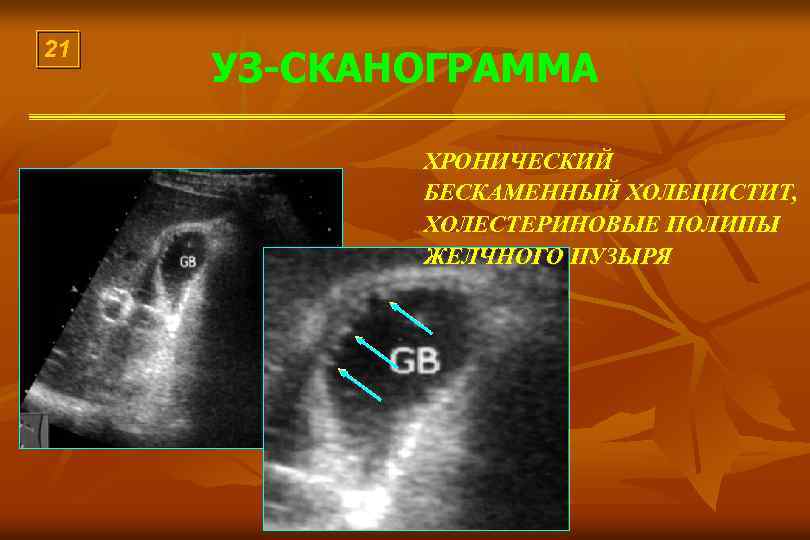 21 УЗ-СКАНОГРАММА ХРОНИЧЕСКИЙ БЕСКАМЕННЫЙ ХОЛЕЦИСТИТ, ХОЛЕСТЕРИНОВЫЕ ПОЛИПЫ ЖЕЛЧНОГО ПУЗЫРЯ 