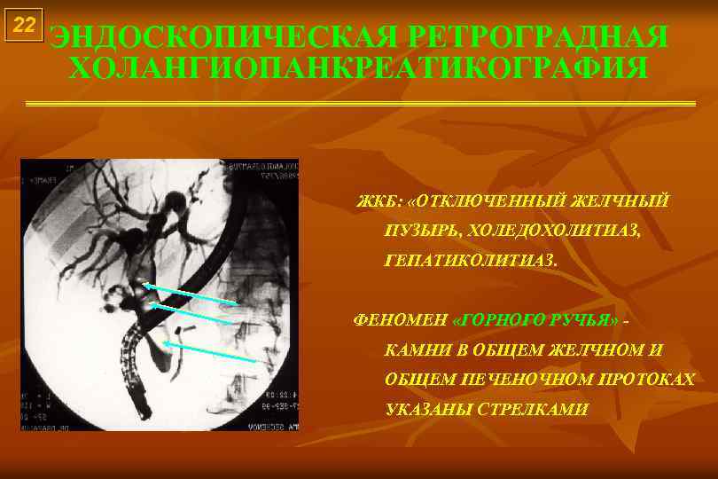 22 ЭНДОСКОПИЧЕСКАЯ РЕТРОГРАДНАЯ ХОЛАНГИОПАНКРЕАТИКОГРАФИЯ ЖКБ: «ОТКЛЮЧЕННЫЙ ЖЕЛЧНЫЙ ПУЗЫРЬ, ХОЛЕДОХОЛИТИАЗ, ГЕПАТИКОЛИТИАЗ. ФЕНОМЕН «ГОРНОГО РУЧЬЯ» КАМНИ