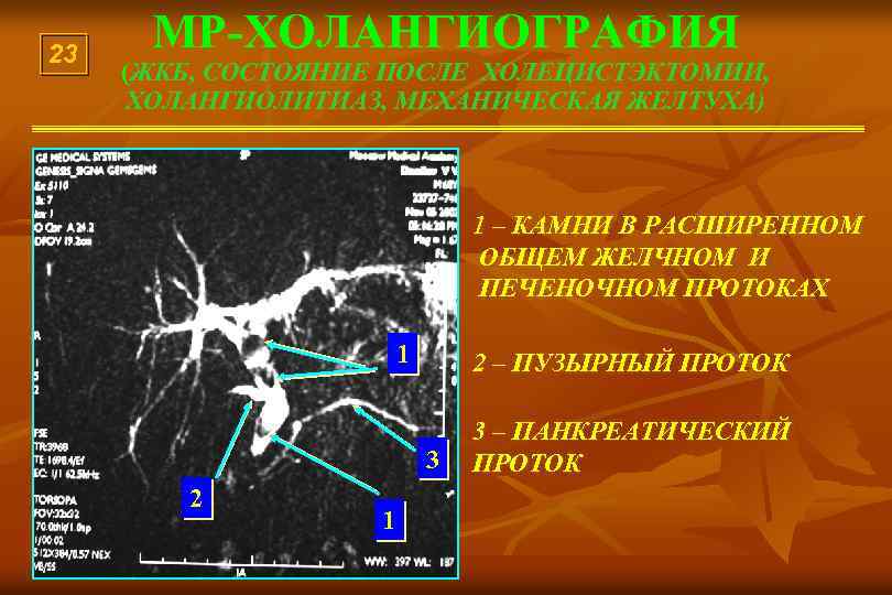 23 МР-ХОЛАНГИОГРАФИЯ (ЖКБ, СОСТОЯНИЕ ПОСЛЕ ХОЛЕЦИСТЭКТОМИИ, ХОЛАНГИОЛИТИАЗ, МЕХАНИЧЕСКАЯ ЖЕЛТУХА) 1 – КАМНИ В РАСШИРЕННОМ