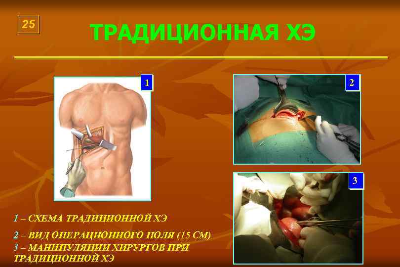 25 ТРАДИЦИОННАЯ ХЭ 1 2 3 1 – СХЕМА ТРАДИЦИОННОЙ ХЭ 2 – ВИД
