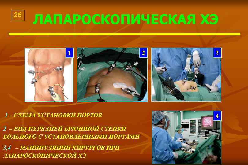26 ЛАПАРОСКОПИЧЕСКАЯ ХЭ 1 1 – СХЕМА УСТАНОВКИ ПОРТОВ 2 – ВИД ПЕРЕДНЕЙ БРЮШНОЙ