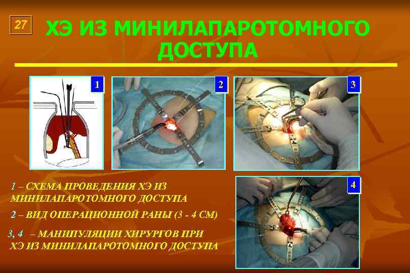 27 ХЭ ИЗ МИНИЛАПАРОТОМНОГО ДОСТУПА 1 2 1 – СХЕМА ПРОВЕДЕНИЯ ХЭ ИЗ МИНИЛАПАРОТОМНОГО